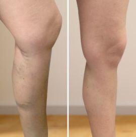 Crema con Veneno de Abeja para el Cuidado de Articulaciones